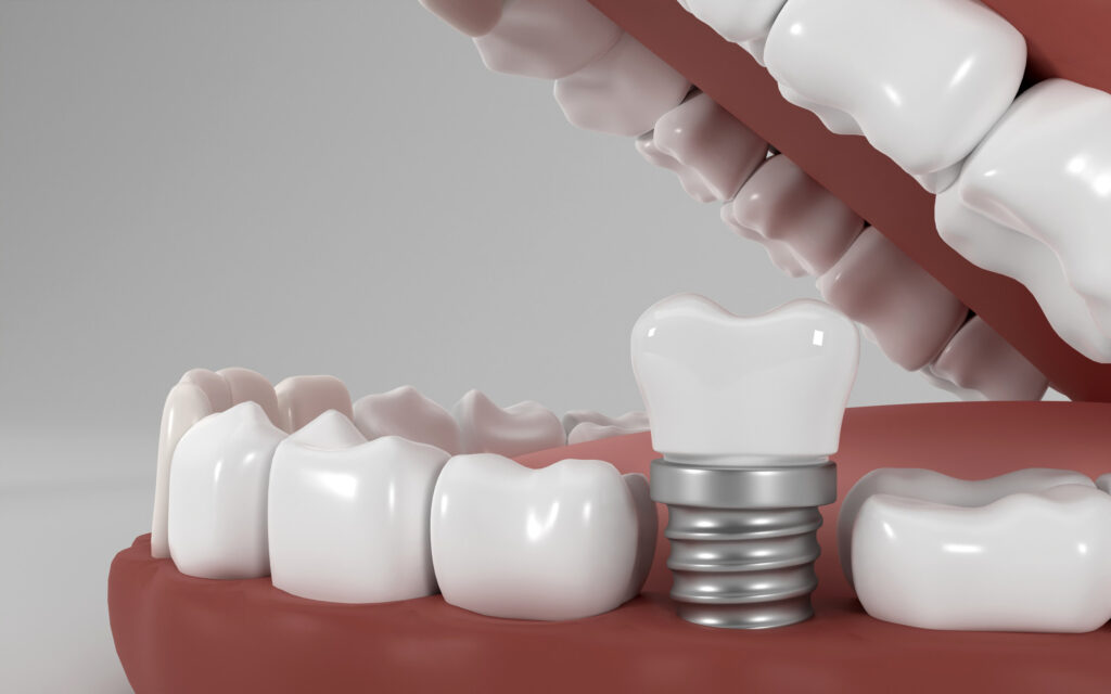 Dental Implants