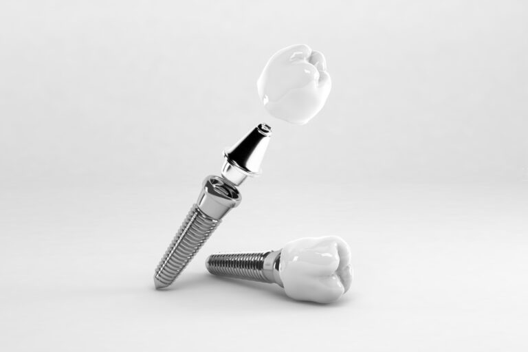 dental implants
